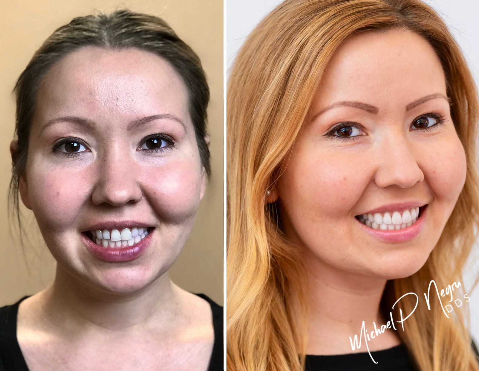 Before and after full-smile reconstruction case at Centric Dental Newport Beach