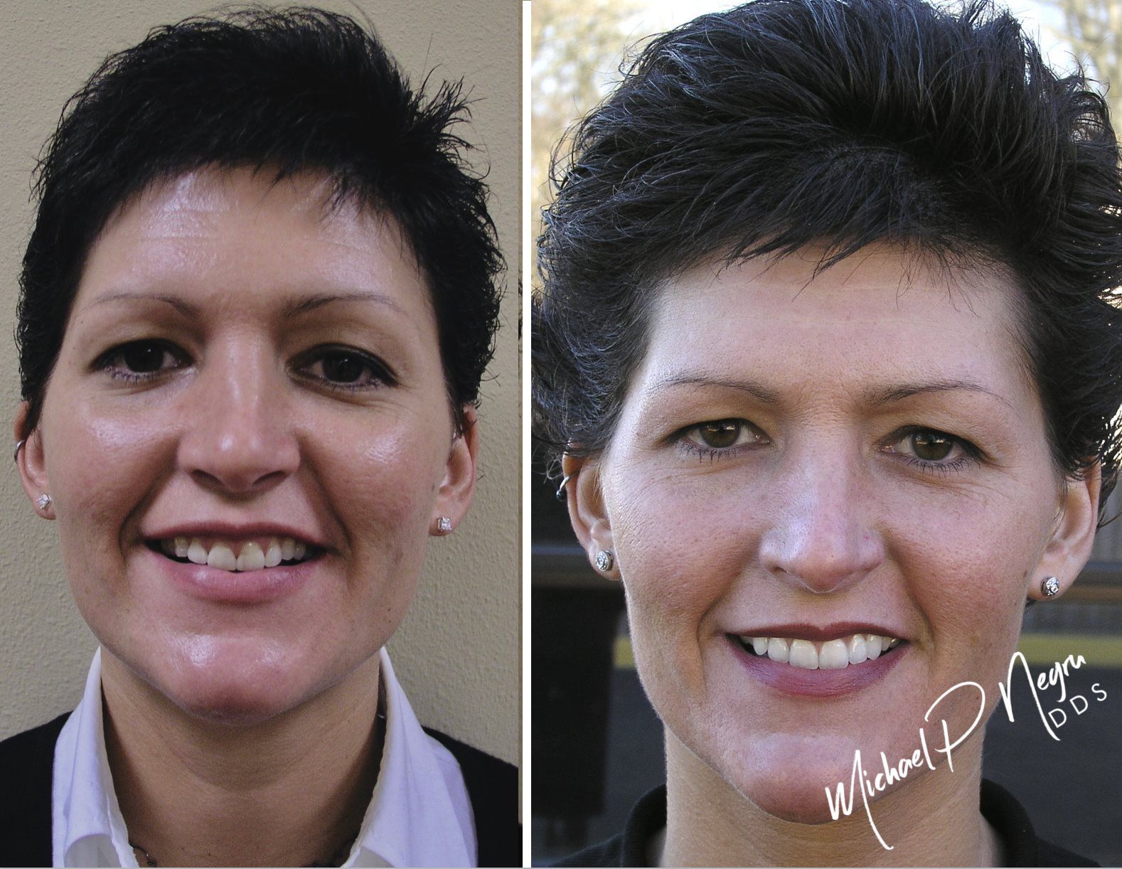 Esthetic dental rehabilitation result showing improved smile symmetry and proportion