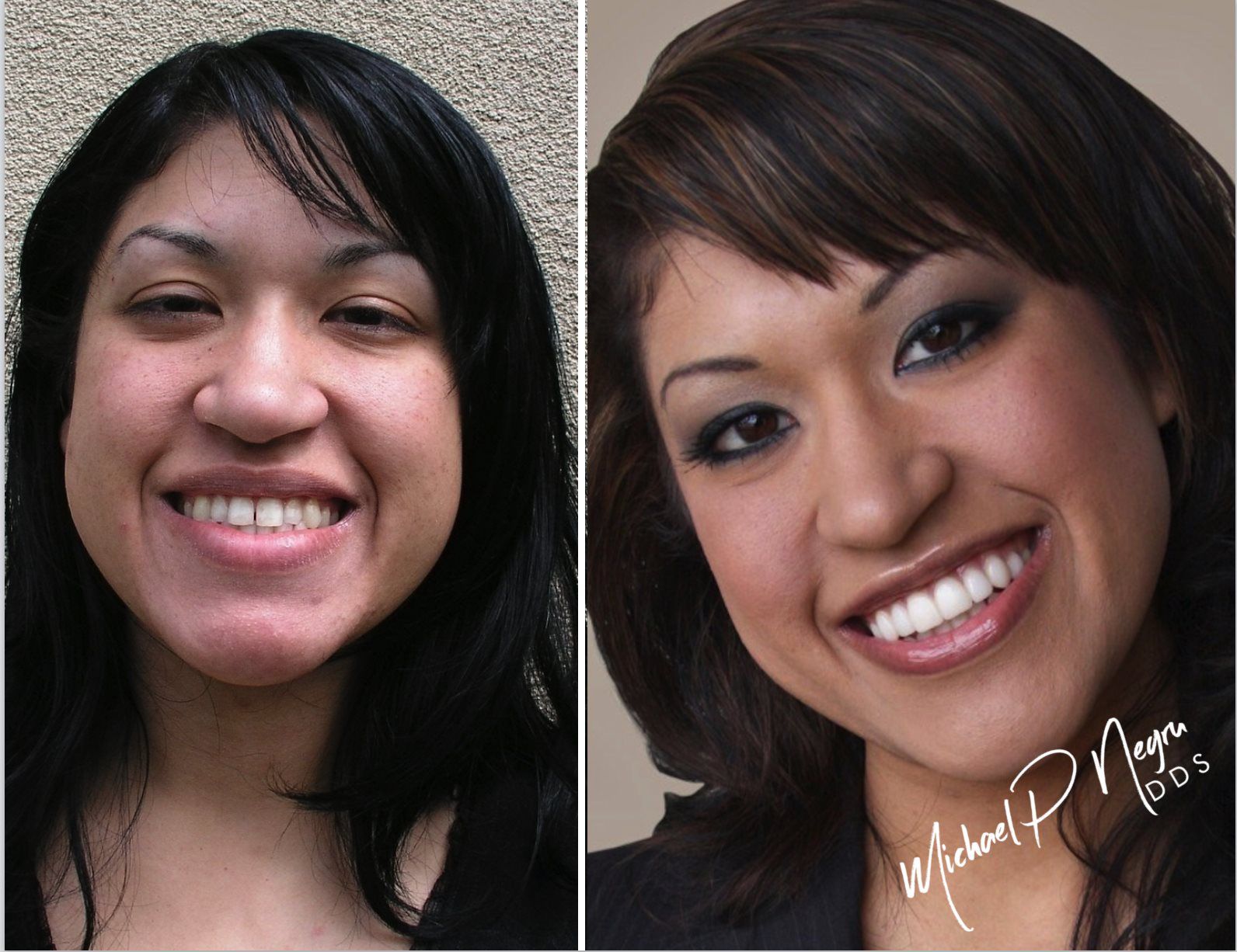 Ceramic dental restoration case showing functional and esthetic outcome