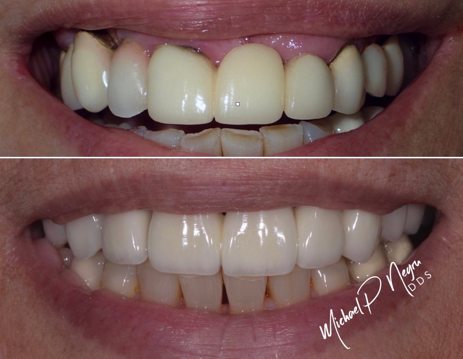 Combined bite and smile rehabilitation case at Centric Dental