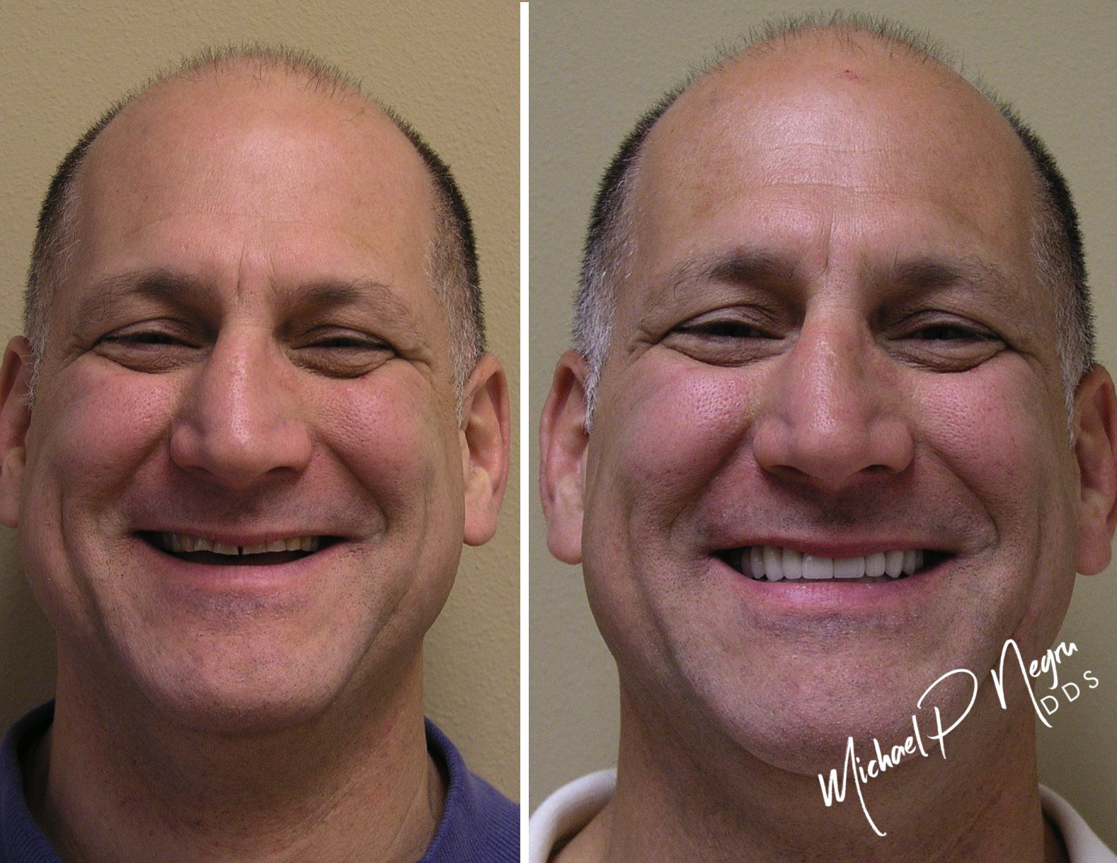 Implant-supported dental restoration case planned within complete bite and smile system